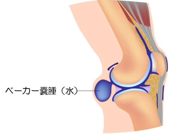 嚢胞 ベーカー