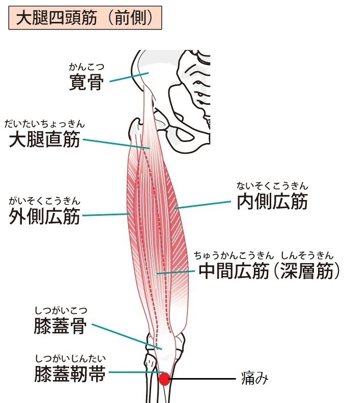 ジャンパー膝 膝蓋靭帯炎 の治療なら西東京市のうえだ整骨院