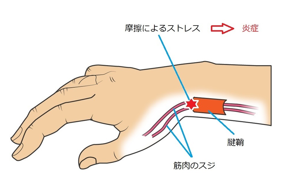 肘 の 腱鞘炎