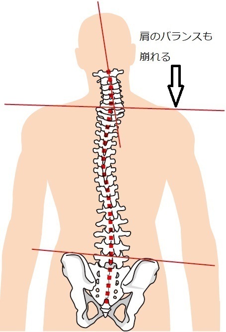 上腕二頭筋腱炎